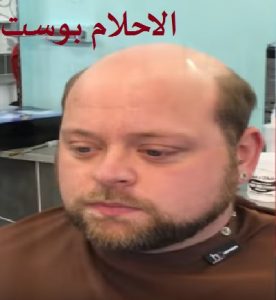 علاج الصلع الوراثي