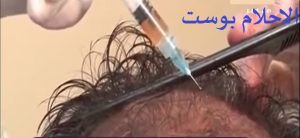 الصلع الوراثي للرجال