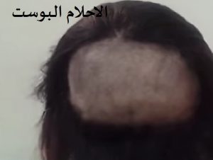 علاج الصلع الوراثي