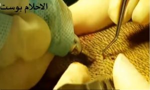 زراعه الشعر للصلع