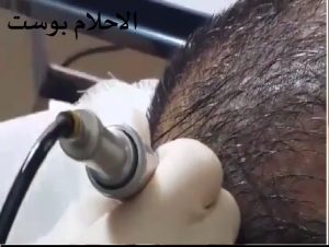 زراع الشعر للصلع