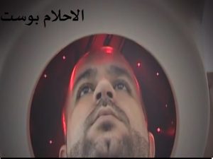 الصلع الوراثي للرجال