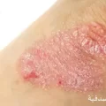 الصدفية وعلاجها