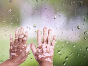 تفسير حلم مرض البرص للمتزوجة