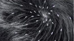 تفسير حلم القمل في المنام لابن سيرين