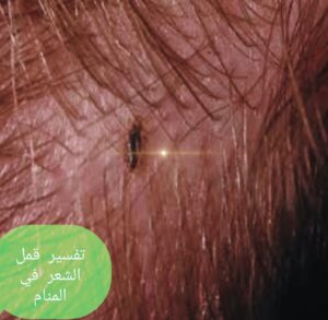 أهم ٧ تفسيرات حلم القمل للثقافات الأخري