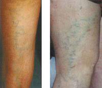 أشكال الدوالي