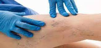 هل الدوالي تسبب ألم في الرجل