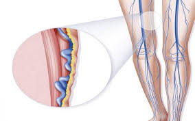 هل الدوالي تسبب ألم في الرجل