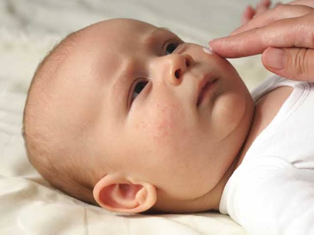 جلد الوزة عند الأطفال