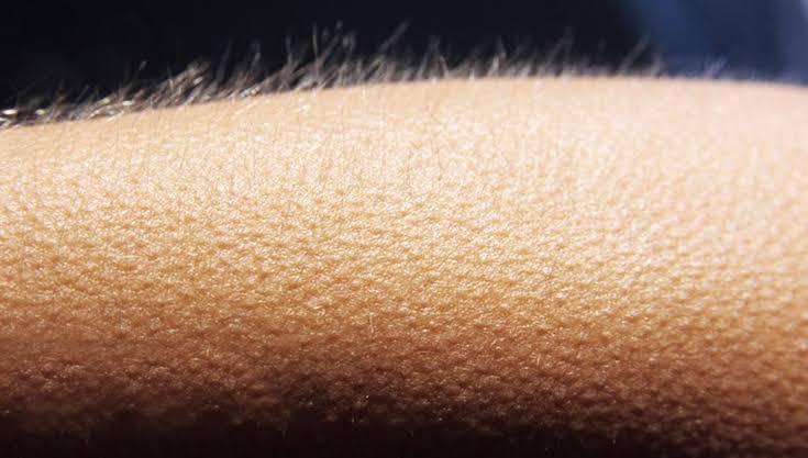 هل السويت يسبب جلد الوزة