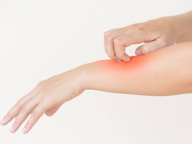 مشكلة طفح الصيف