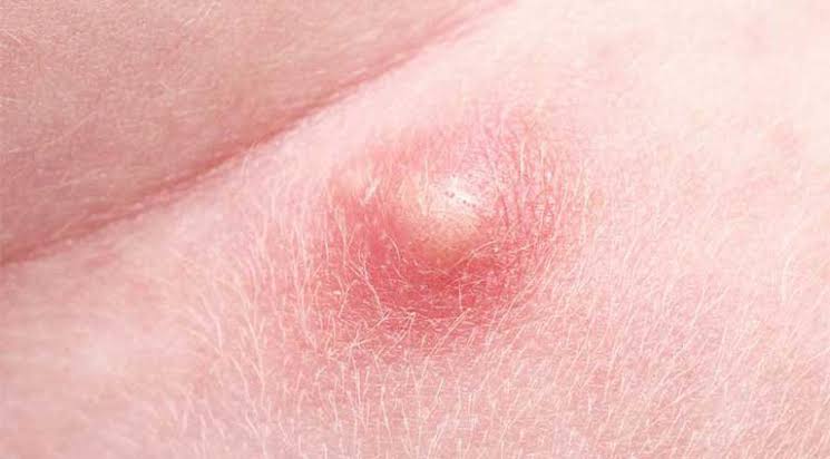 حل مشاكل الحبوب تحت الجلد