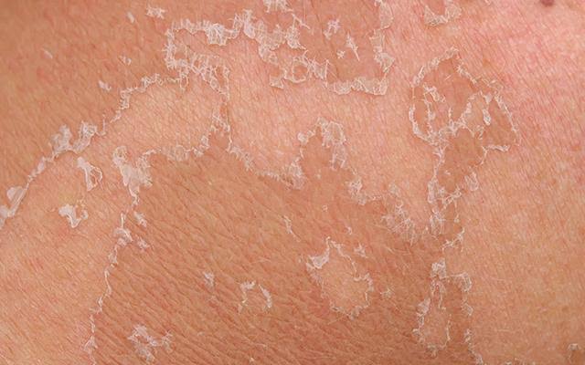 حل مشكلة الجلد الميت