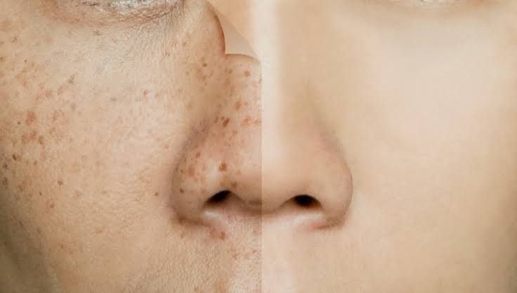 حل مشكلة تصبغات الجلد