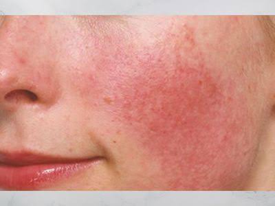 مشاكل البشرة الحساسة