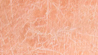 مشاكل البشرة الجافة