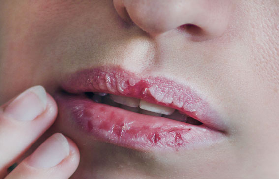 كيفية الوقاية من جفاف وتشقق الشفتين