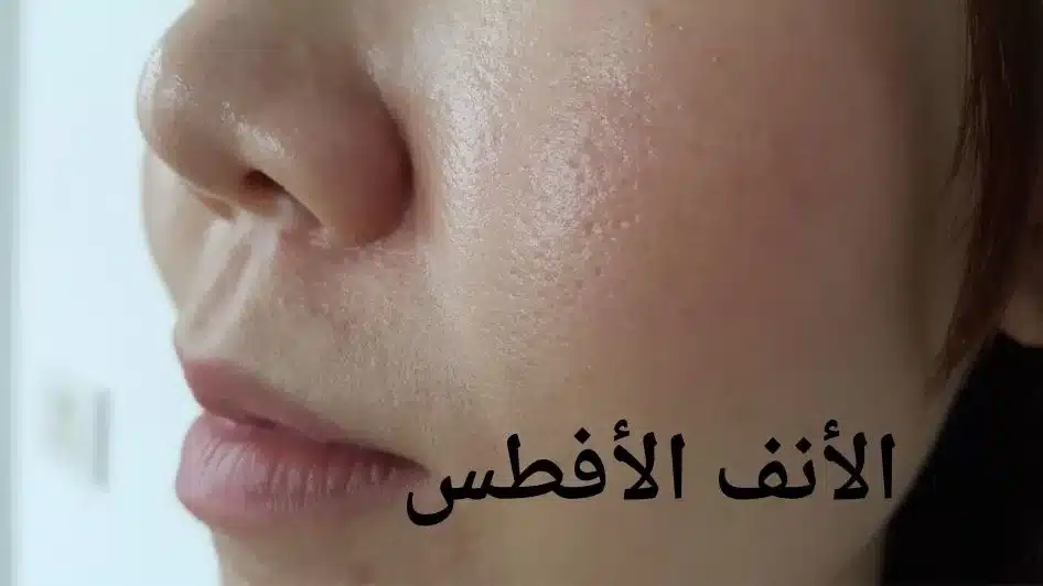 الأنف الأفطس