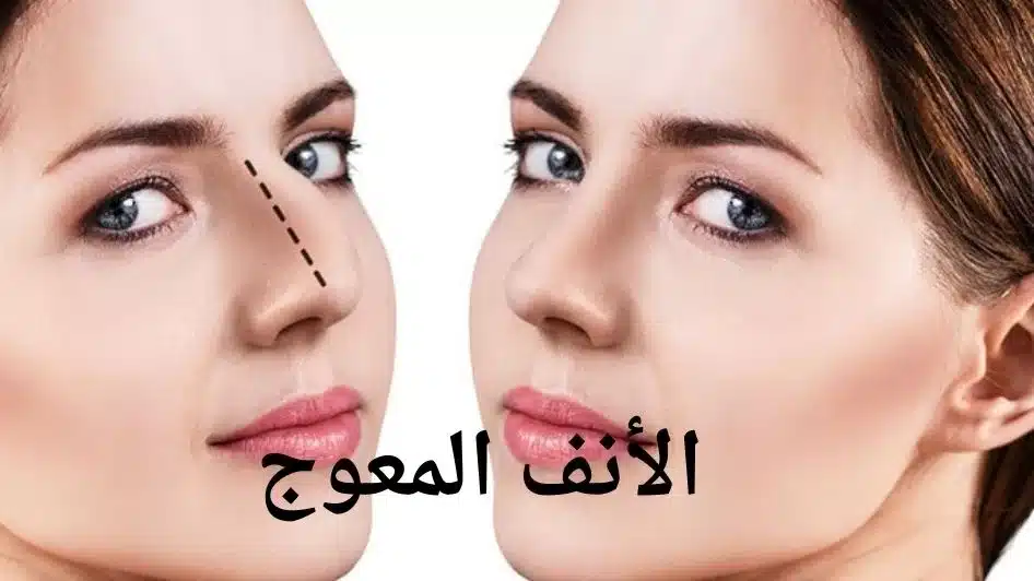 الأنف المعوج