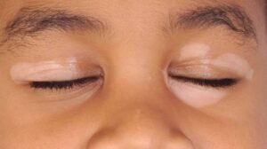 رؤية البرص لشخص ما