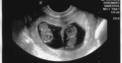 موجات فوق صوتية للحمل بتوأم