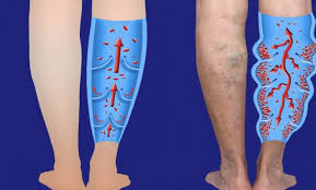 أسباب الدوالي