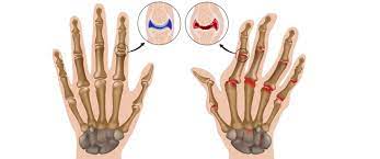 فوائد الياقوت في علاج مرض الروماتيزم